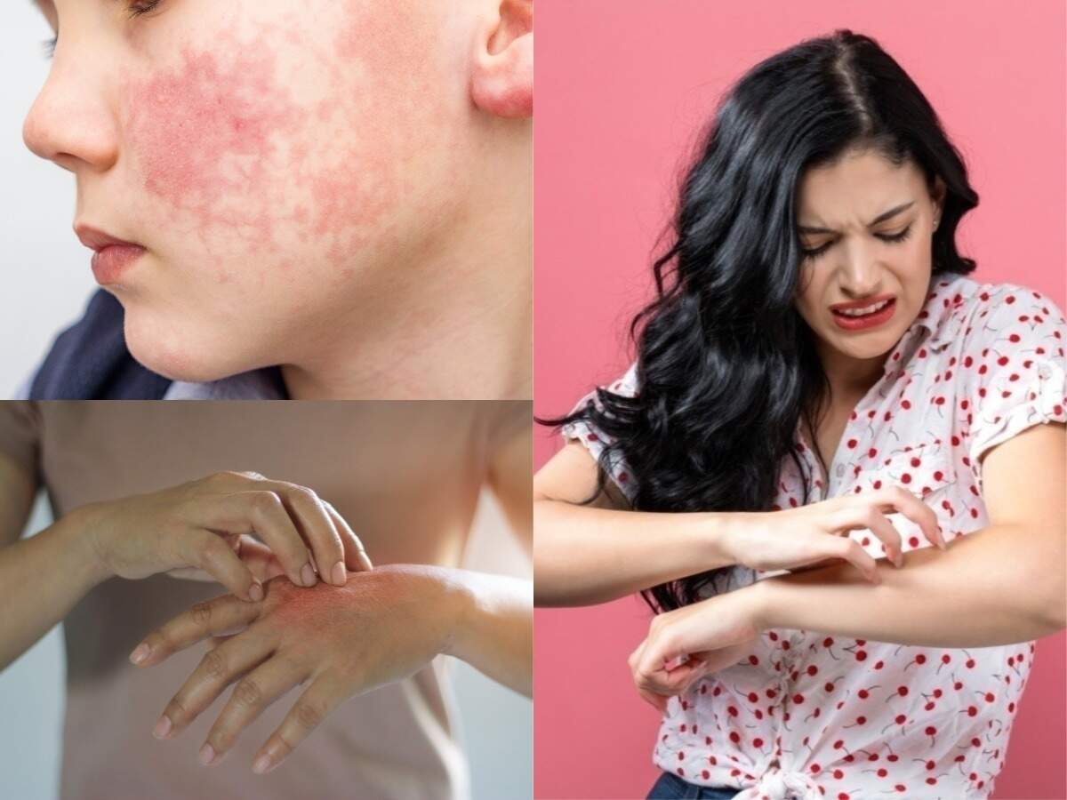 Skin Symptoms of Covid 19: covid-19 can cause inflammation on the skin here are 3 signs to check for - Coronavirus symptoms: त्‍वचा के ऊपर इन 3 तरह से दिखाई देते हैं