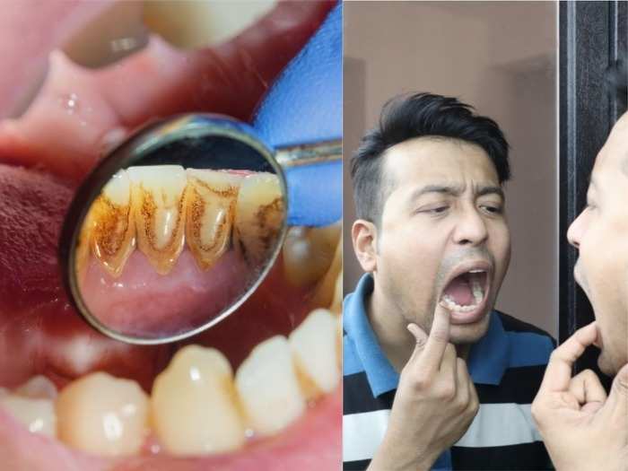 how to remove plaque from teeth at home naturally