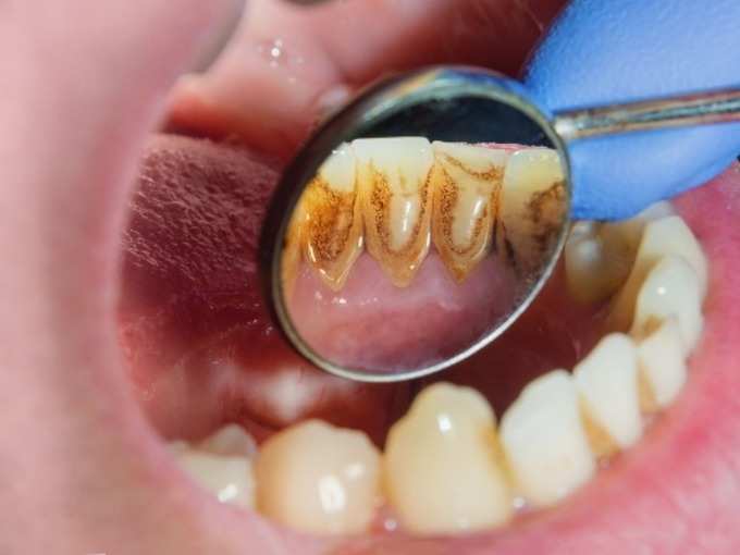 दांतों में सडन की समस्या