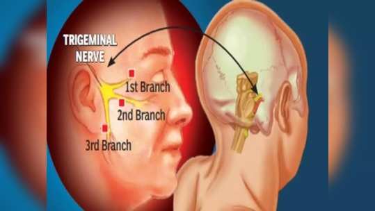 चेहरा, हिरडी, नाकपुडी व कपाळामध्ये असह्य वेदना निर्माण करणारा ट्रायजेमिनल न्यूराल्जिया आजार नेमका काय आहे व यावर सुरक्षित उपचार काय?