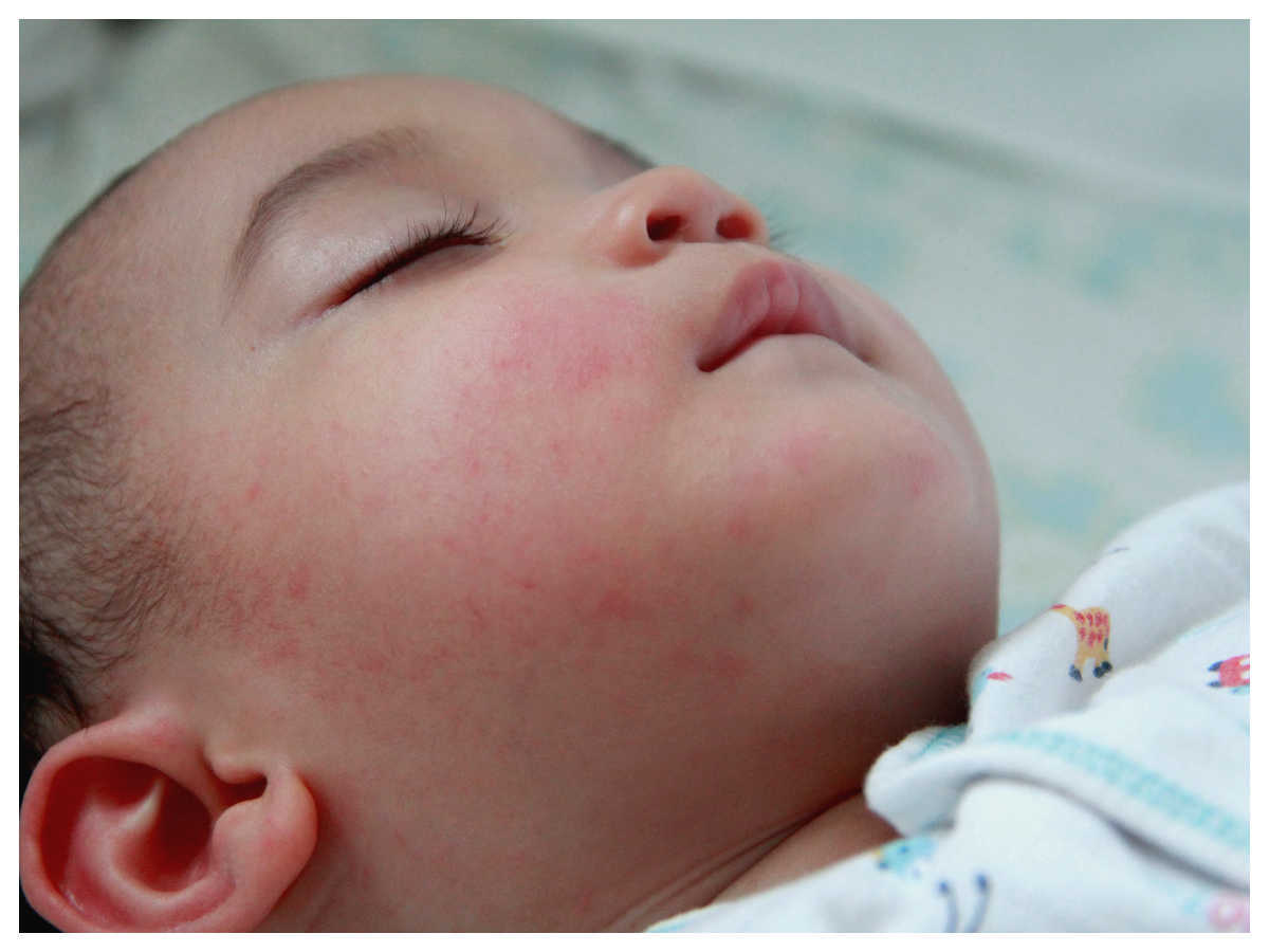 What Causes Eczema In Babies And Toddlers Eczema In Babies And Toddlers गर म म बच च क फ स य नह ह रह ह ठ क ध य न स द ख कह एक ज म त नह अभ ध य न