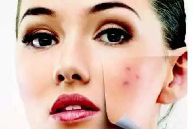 tips to prevent pimple scars: முகம் முழுக்க பருக்களா, வடுவாக மாறாமல் இருக்க இதை ஃபாலோ பண்ணுங்க! - how to avoid pimple turning into scar in tamil 5 samayam tamil Tamil News Spot