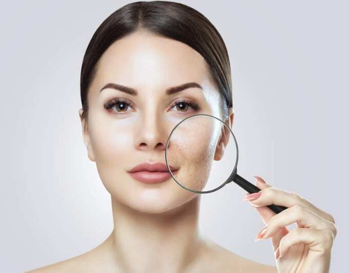 tips to prevent pimple scars: முகம் முழுக்க பருக்களா, வடுவாக மாறாமல் இருக்க இதை ஃபாலோ பண்ணுங்க! - how to avoid pimple turning into scar in tamil 4 samayam tamil Tamil News Spot