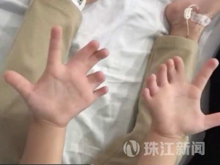 Chinese Girl Born With 14 Fingers And 13 Toes ह थ म 14 और प र म 13 उ गल य क स थ प द ह ई थ लड क अब 4 स ल क उम र म ऑपर शन Navbharat Times