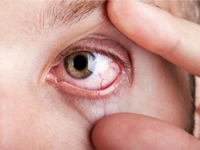 ​आंखों के फ्लोटर्स के लक्षण