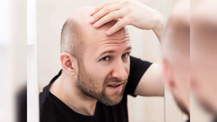 Baldness in men :‘या’ ६ गंभीर चुकांमुळे पुरूषांचे तरूण वयातच पडते टक्कल! डॉक्टरांनी सांगितले हे उपाय! 