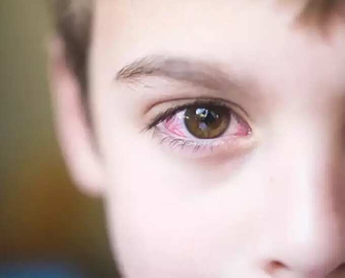 swollen eyes in babies: குழந்தைங்க கண்ணு வீங்கறது ஆபத்தா ? என்ன காரணம் ? வீட்டு வைத்தியம் உண்டா? 5 samayam tamil Tamil News Spot