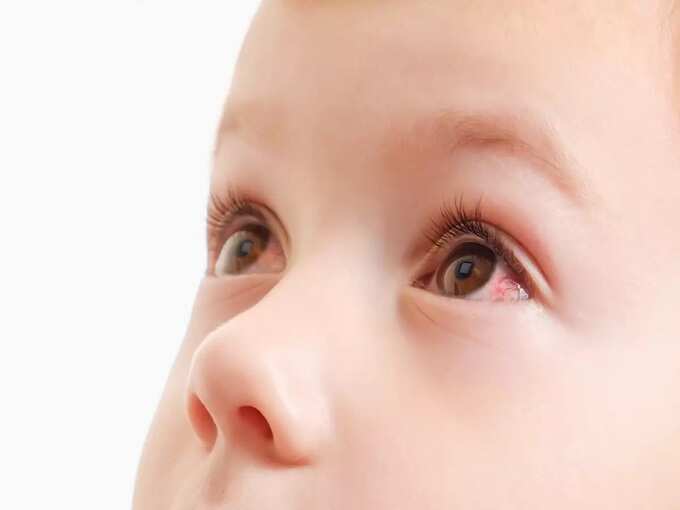 swollen eyes in babies: குழந்தைங்க கண்ணு வீங்கறது ஆபத்தா ? என்ன காரணம் ? வீட்டு வைத்தியம் உண்டா? 3 samayam tamil Tamil News Spot