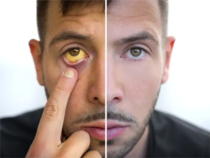 liver cirrhosis symptoms: cirrhosis of the liver 5 early signs of this disease in hindi - Liver problems: ऐसे लोगों को लीवर सिरोसिस का होता है ज्‍यादा खतरा, दिखे इनमें से एक