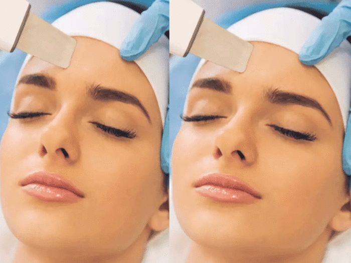 dermaplaning is a complexion-smoothing skincare technique know how to do it at home