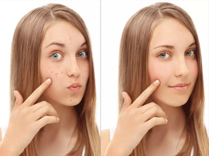 Glycerin For Oily Skin : எண்ணெய் வழியிற முகத்தையும் மென்மையாக்க உதவும் கிளிசரின்? 8 samayam tamil Tamil News Spot