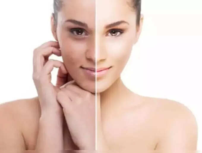 Glycerin For Oily Skin : எண்ணெய் வழியிற முகத்தையும் மென்மையாக்க உதவும் கிளிசரின்? 7 samayam tamil Tamil News Spot