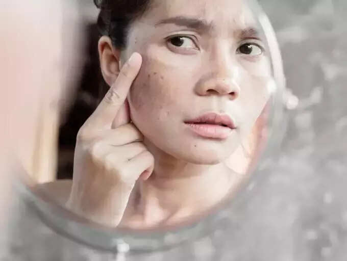 Glycerin For Oily Skin : எண்ணெய் வழியிற முகத்தையும் மென்மையாக்க உதவும் கிளிசரின்? 3 samayam tamil Tamil News Spot