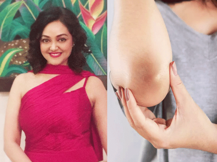skin expert dermatologist rashmi shettyra tips to remove elbow and knee darkness