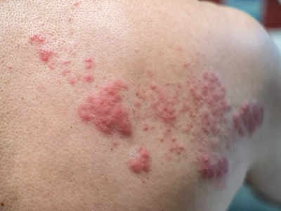 Skin fungal infection: केवल दाद-खुजली ही नहीं, स्‍किन पर होते हैं ये भयानक फंगल इंफेक्‍शन भी; ऐसे होता है उपचार 