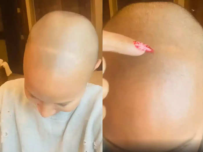jada pinkett smith shares another update regarding her extreme hair fall and baldness due to alopecia