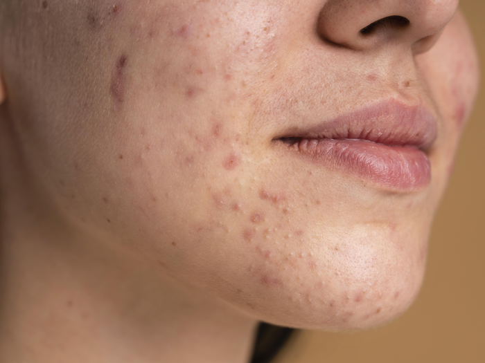 ayurvedic expert shares tips to get rid of acne problem