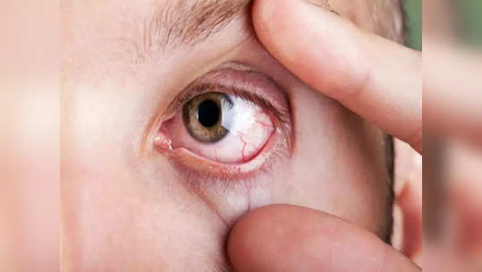 <strong>Symptoms of High Cholesterol :</strong> कोलेस्ट्रॉल वाढल्यावर येऊ शकतो हार्ट अटॅक, कोलेस्ट्रॉल वाढल्यास डोळ्यांवर दिसतात 'ही' लक्षणे, लगेच करा चेकअप!