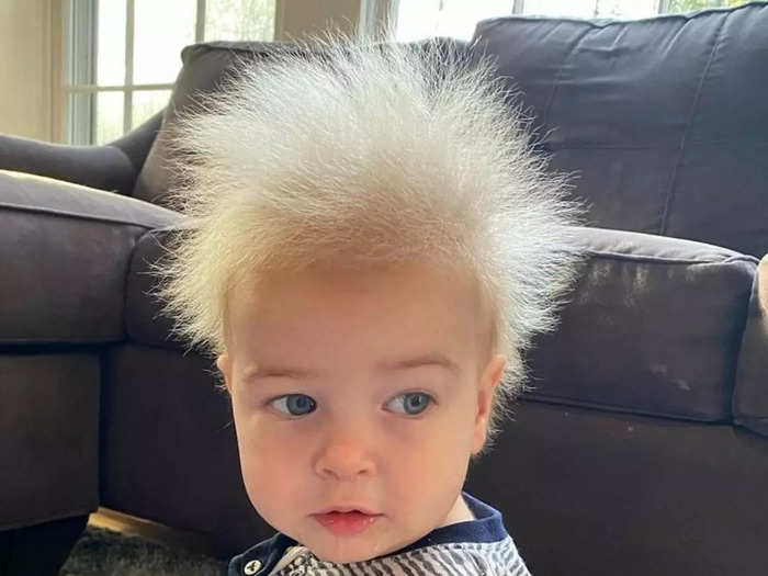 uncombable hair syndrome