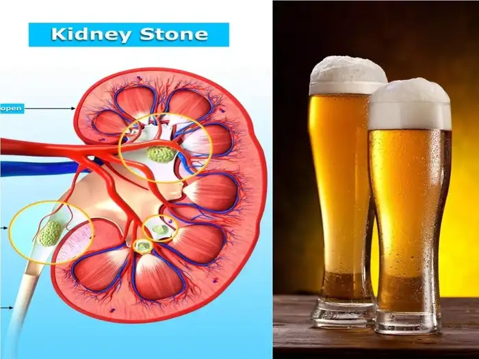 on the occasion of world kidney day know does drinking beer help kidney