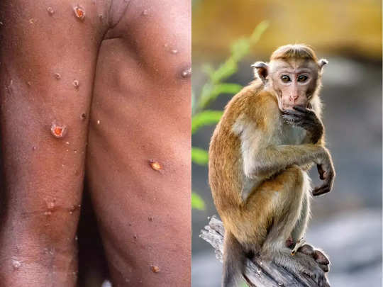 भयंकर हुआ Monkeypox, WHO की चेतावनी-12 देशों में फैला, 8 लक्षणों को न करें नजरअंदाज 