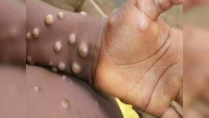 monkeypox patients found in 12 countries 