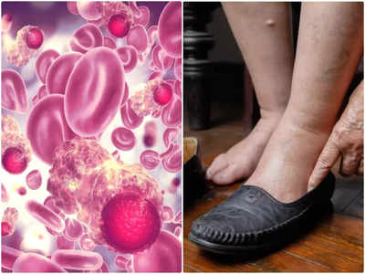 Pancreatic Cancer: पैरों में सबसे पहले दिखाई देने लगते हैं इस कैंसर के लक्षण, न आनें दें पहली स्‍टेज की नौबत 
