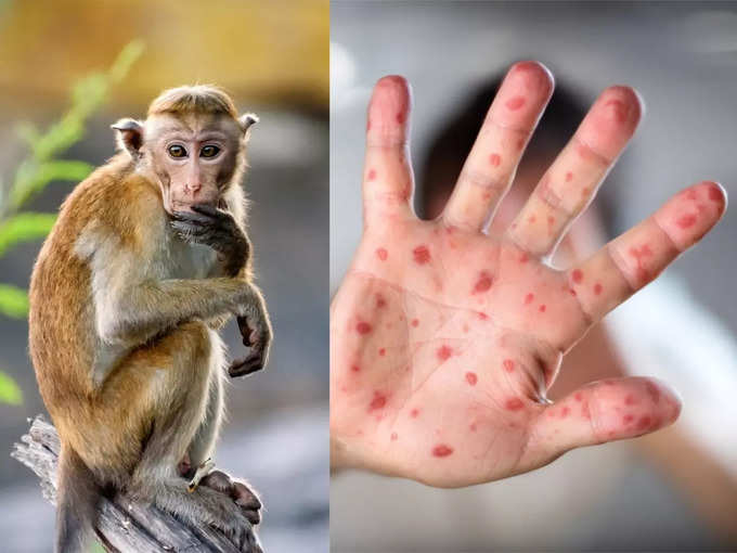 Monkeypox Case in Delhi: Monkeypox first case confirmed in delhi, read all  the symptoms of monkeypox here