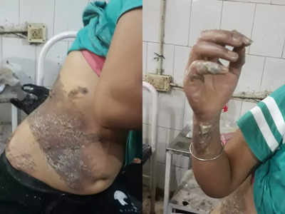 Muzaffarpur Acid Attack : तीन दिन पहले हुआ था हमला, अब तक FIR नहीं... वाह री बिहार पुलिस 