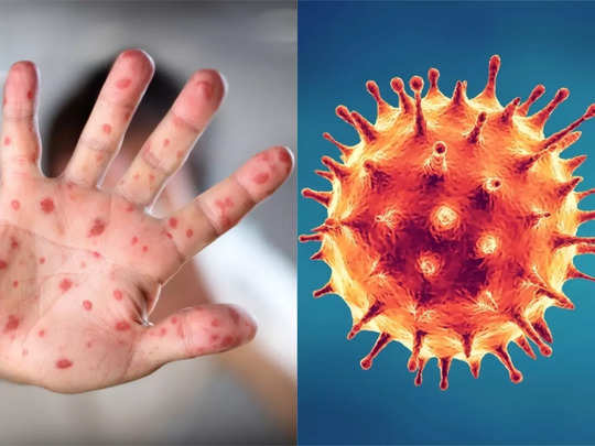 Monkeypox vs COVID: कोरोना को टक्कर देता हुआ 30 देशों में फैला मंकीपॉक्स, मिलते-जुलते हैं दोनों के लक्षण, 5 तरीकों से करें पहचान 