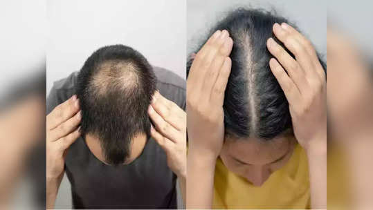 <strong>Baldness Treatment : </strong>तरूणपणात का पडू लागलंय मुला-मुलींचं टक्कल? औषधं न घेता हवे असतील लांबसडक, घनदाट व काळेभोर केस, तर करा Cosmetic Surgeon चे 'हे' उपाय…!