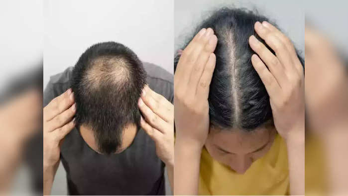 Baldness Treatment : तरूणपणात का पडू लागलंय मुला-मुलींचं टक्कल? औषधं न घेता हवे असतील लांबसडक, घनदाट व काळेभोर केस, तर करा Cosmetic Surgeon चे 'हे' उपाय…!