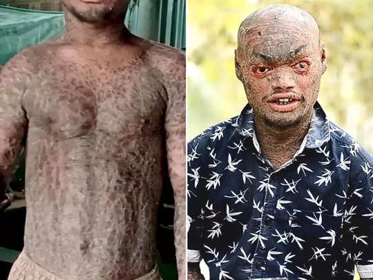 बिहार: सांप की तरह झड़ती है 25 वर्षीय युवक की त्वचा, इस दुर्लभ बीमारी से है पीड़ित 