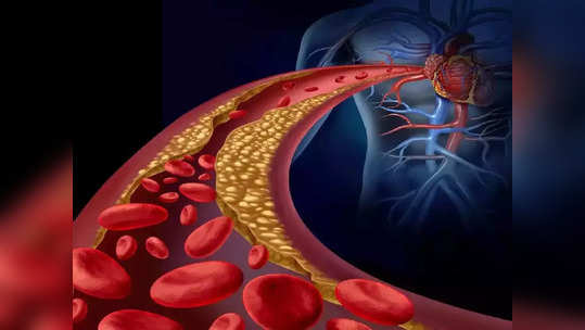 <strong>How to reduce cholesterol : </strong>भयंकर, हार्ट अटॅक व हार्ट स्ट्रोकचं खरं कारण आहे खराब कोलेस्ट्रॉल, ताबडतोब ‘हे’ 5 पदार्थ खाण्याची आवश्यकता..!