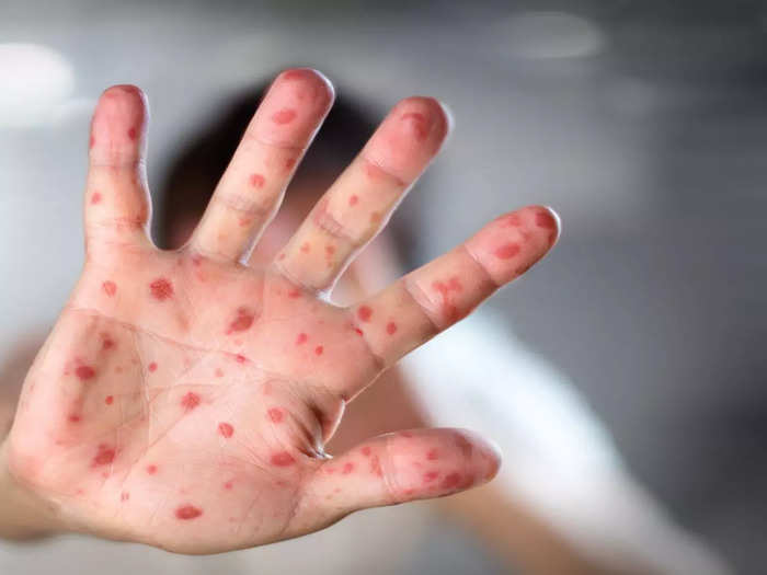 Monkeypox in India: भारत में घुसा 'मंकीपॉक्स', केरल में मिला पहला मामला, इन  6 लक्षणों पर रखें कड़ी नजर - india's first monkeypox case in kerala, know  what is monkeypox and 6