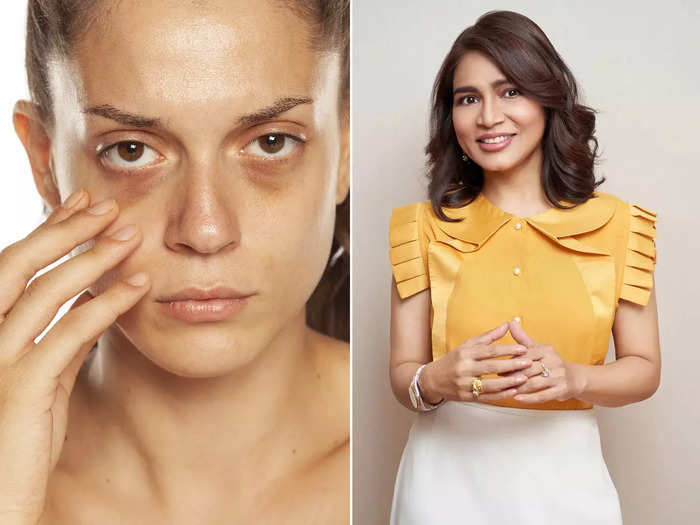 3 reasons for dark circles and its treatment shared by doctor jaishree sharad