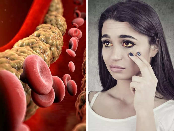 3 high cholesterol symptoms you can see in your eyes, eat canned beans to lower bad cholesterol