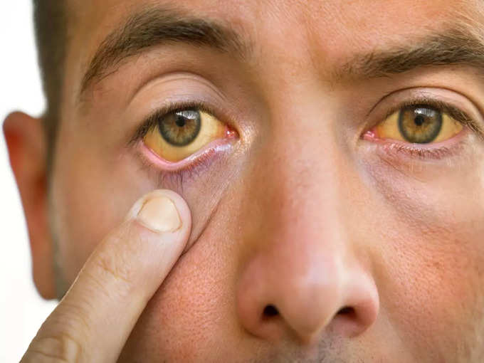 These symptoms of lack of blood in the body will be visible in the eyes,  start eating these 8 things