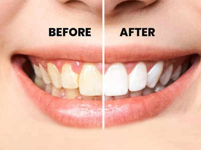 Teeth Whitening Solution :​ ​दांतों पर जमी बत्तीसी और पीलेपन को करना है दूर, तो इन 5 पाउडर से मिलेगी काफी मदद 
