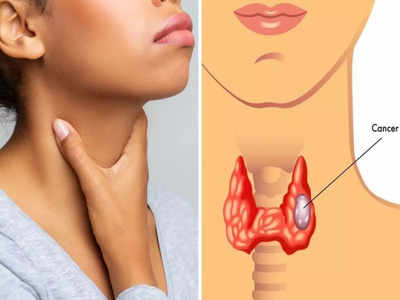 लड़कियों में तेजी से बढ़ रहा जानलेवा Thyroid cancer, इन 8 लक्षणों को न करें इग्नोर