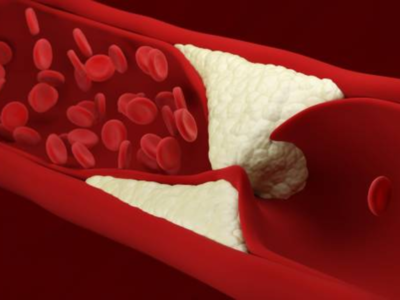Cholesterol risk factors: వీరికి అధిక కొలెస్ట్రాల్‌ ముప్పు.. 100 రెట్లు ఎక్కువగా ఉంటుంది..!