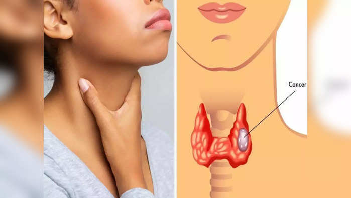 तिशीतल्या मुलींमध्ये वाढतोय जीवघेणा Thyroid Cancer, थकवा-गळ्याचं दुखणं यासारख्या 8 लक्षणांकडे करू नका दुर्लक्ष