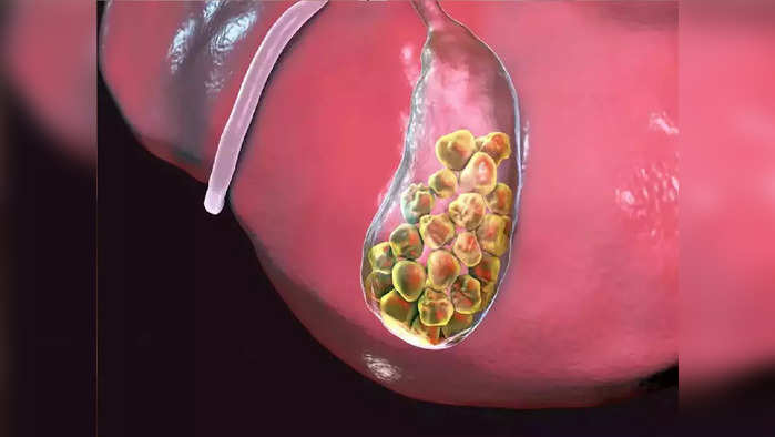 Gallstone Pain: ज्याला पोटातील गॅस समजताय तो असेल जीवघेणा पित्ताचा खडा, ही 6 लक्षणे अजिबात करू नका दुर्लक्षित