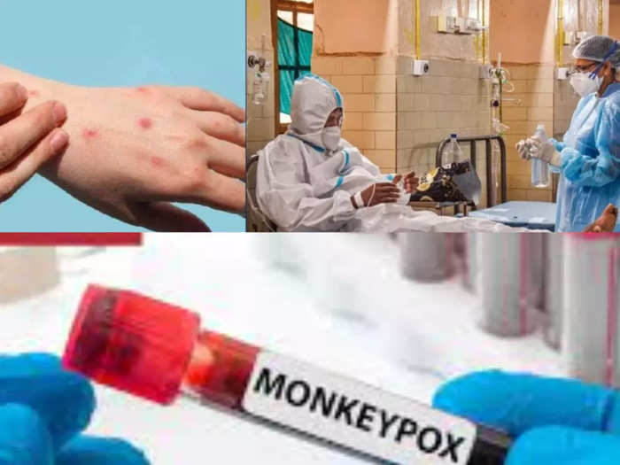 monkeypox in Delhi