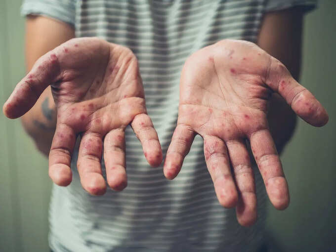 Measles suddenly spread in Mumbai, 3 deaths in 48 hours, only these 4 symptoms appear at the beginning | Hits Times 95427408 | Hits Times
