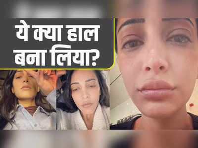 Shruti Haasan: ये क्या हाल बना लिया? श्रुति हासन का सूजा हुआ चेहरा और बिखरे बाल देख फैंस को हुई चिंता 