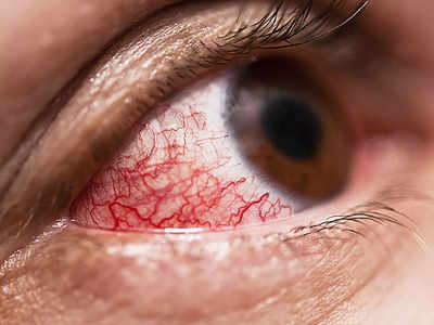 Pink Eyes Symptoms: ചെങ്കണ്ണ് രോഗം പടരുന്നു, ഈ കാര്യങ്ങൾ ശ്രദ്ധിക്കാൻ മറക്കരുത്