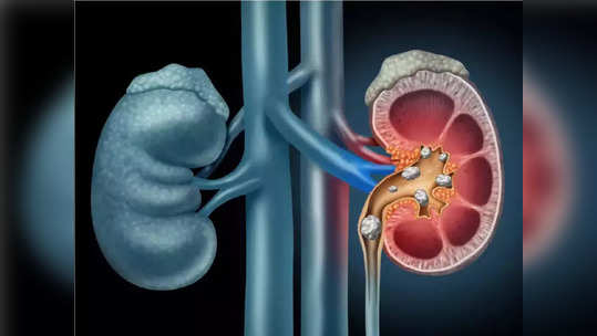 पोटात वेदना, किडनी स्टोन किंवा मुतखडा यासोबत ही 6 लक्षणे असतात किडनीतील रक्ताच्या गाठीचे संकेत, काय करावे उपाय