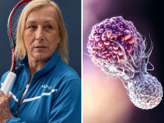 Martina Navratilova टेनिस लीजेंड को हुआ Throat-Breast Cancer, गले में दिखा लक्षण; जानें किसे होता है डबल कैंसर 