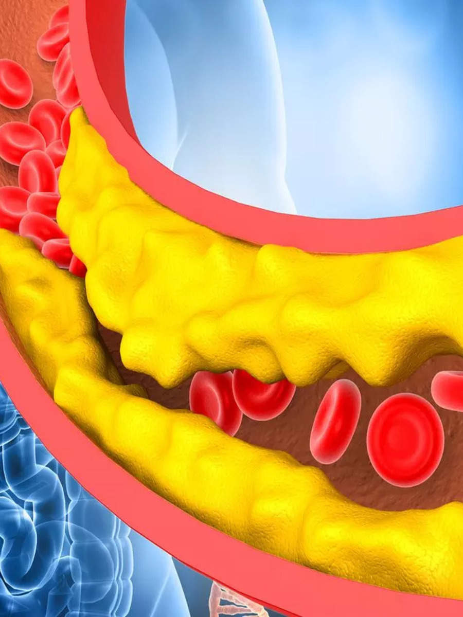 cholesterol-causes-what-is-the-main-causes-of-high-cholesterol